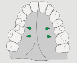 Implantación de tornillos